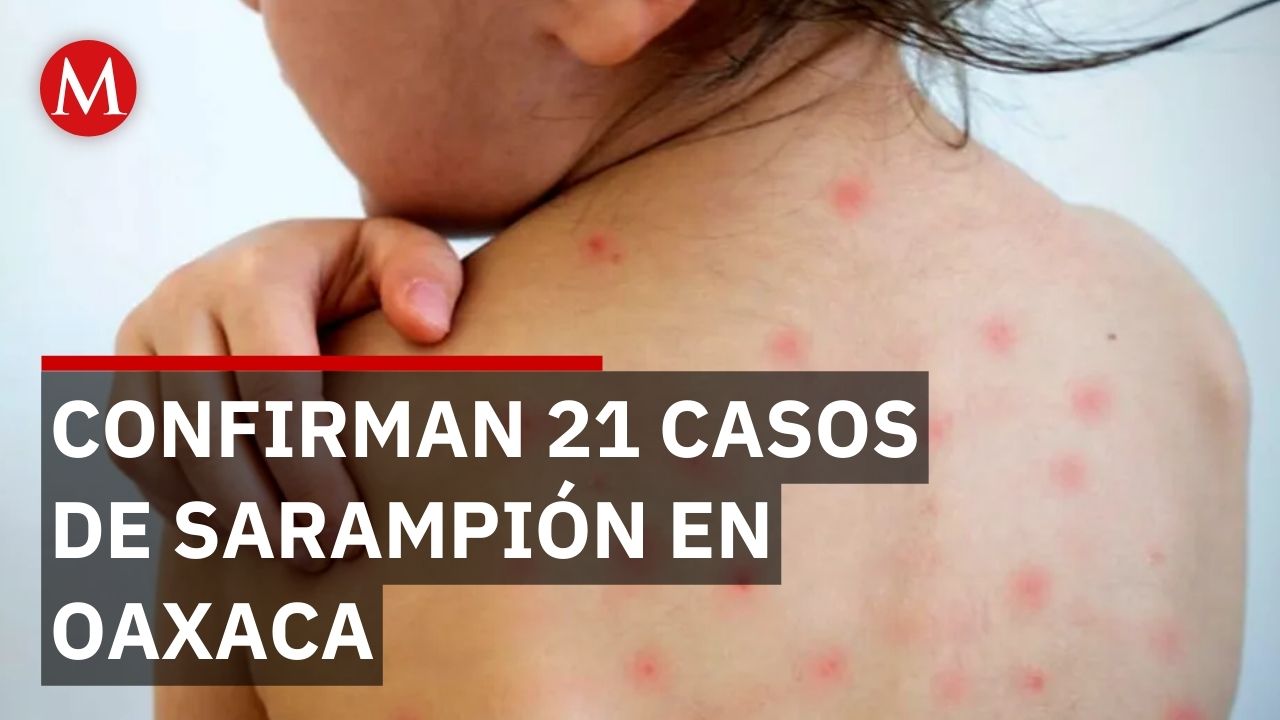 Oaxaca en alerta por sarampión: Reportan contagios en menores de 5 a 7 años