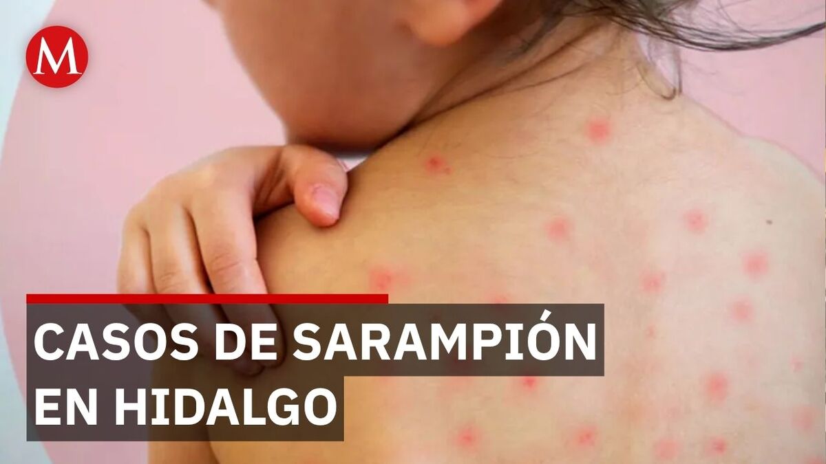Alerta sanitaria en Hidalgo: Reportan 18 casos de sarampión y refuerzan vacunación