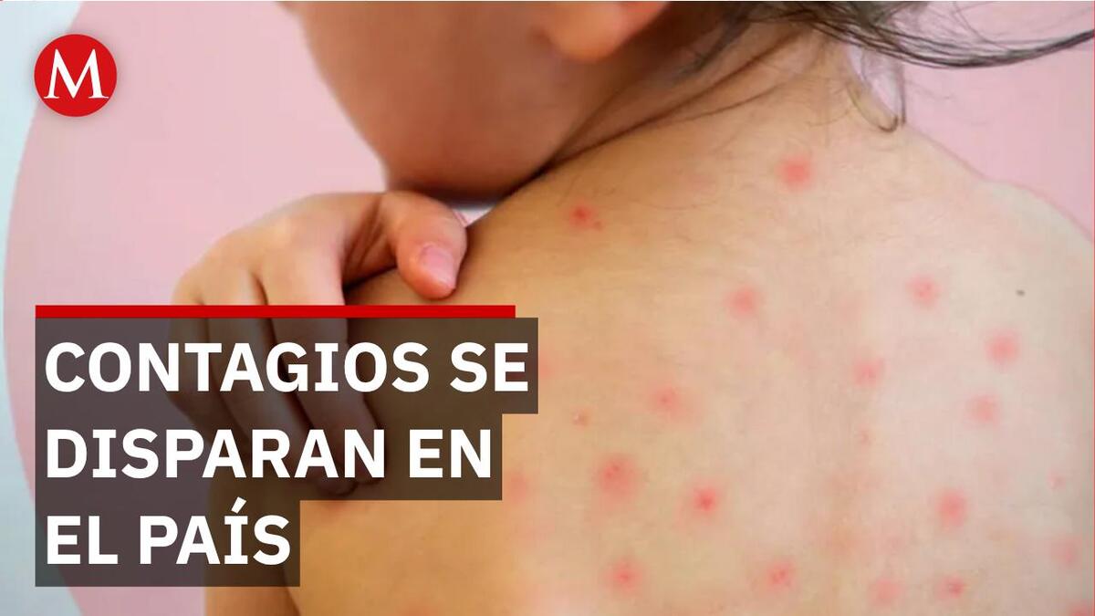 Alerta sanitaria: México supera los 14 mil casos de sarampión