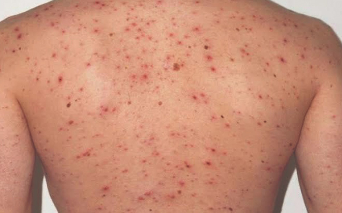 Se han confirmado 265 casos positivos, reporta el sistema de salud. ARCHIVO