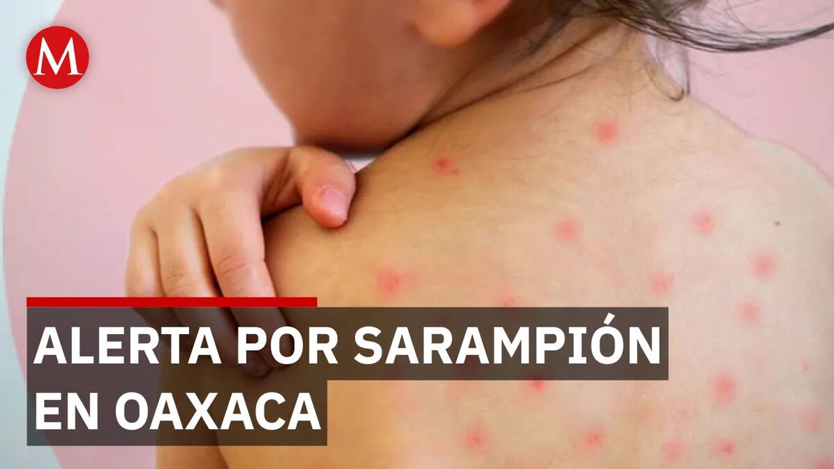 Reportan 32 casos confirmados de sarampión en menores de edad en Oaxaca