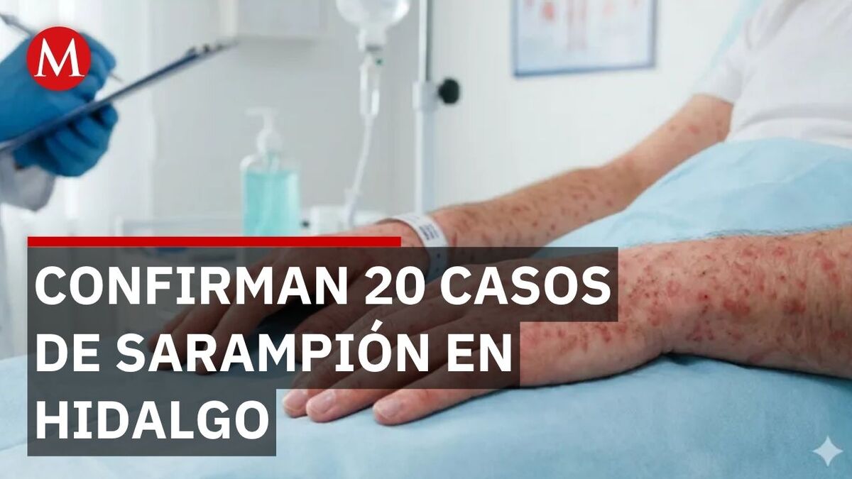 Secretaría de Salud confirma 20 contagios de sarampión en Hidalgo