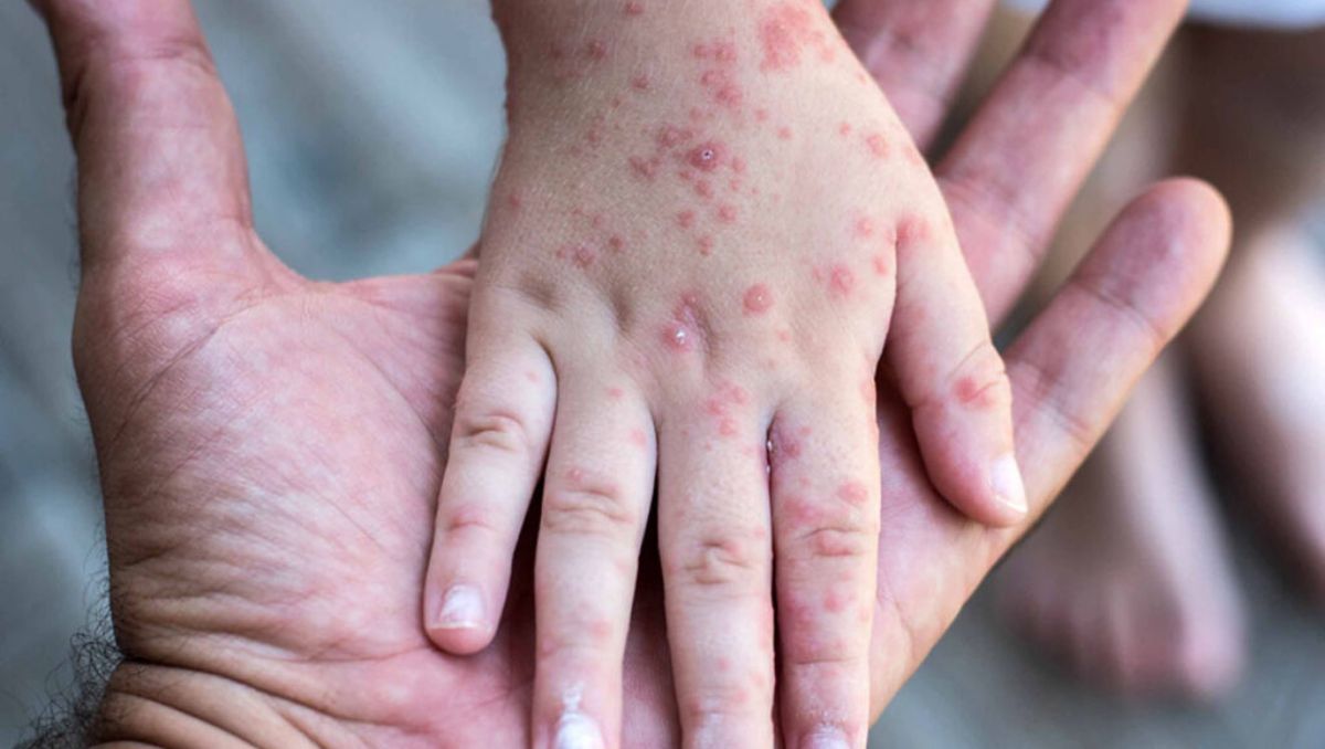 Por el lado de las cifras nacionales, el 7 de abril se registraron 68 casos positivos | Especial