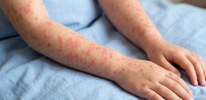 Nuevo León se coloca en el lugar 16 nacional con 47 casos confirmados, teniendo la misma cantidad que Baja California y Querétaro.