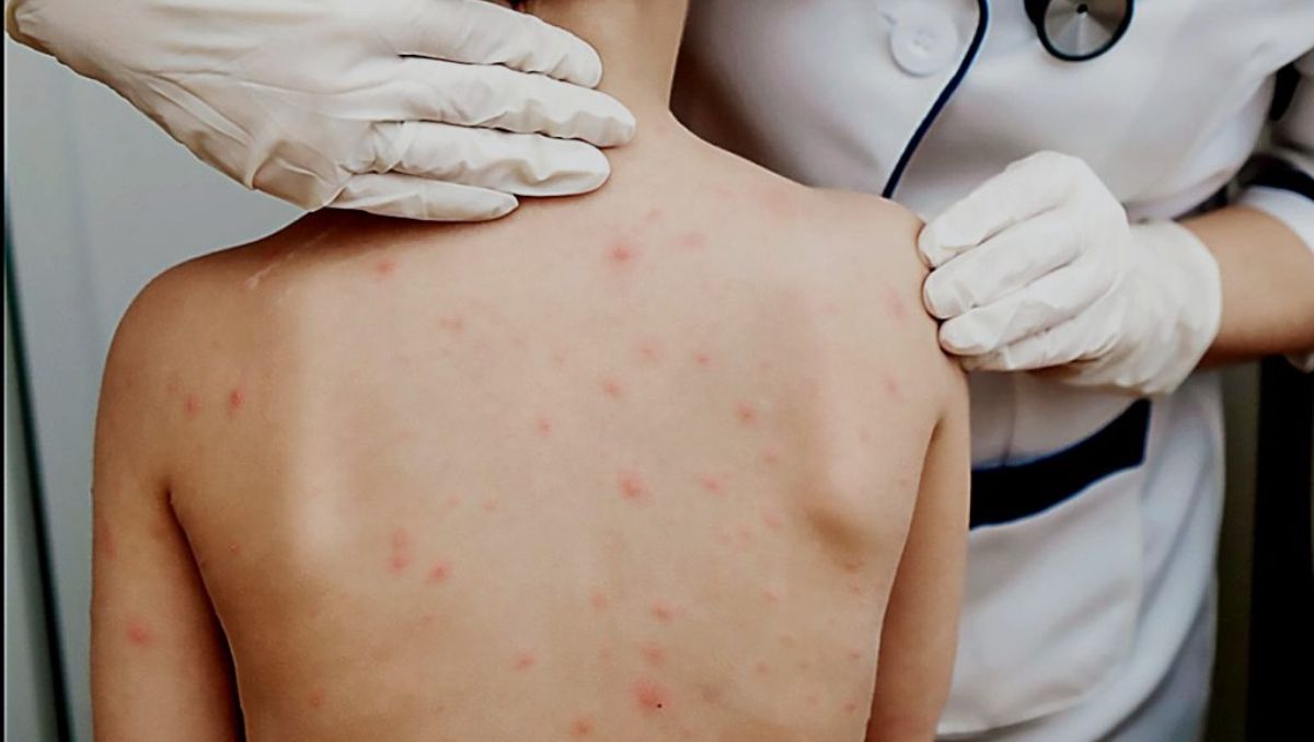 Nuevo León suma un caso más de sarampión en 2026 | Especial