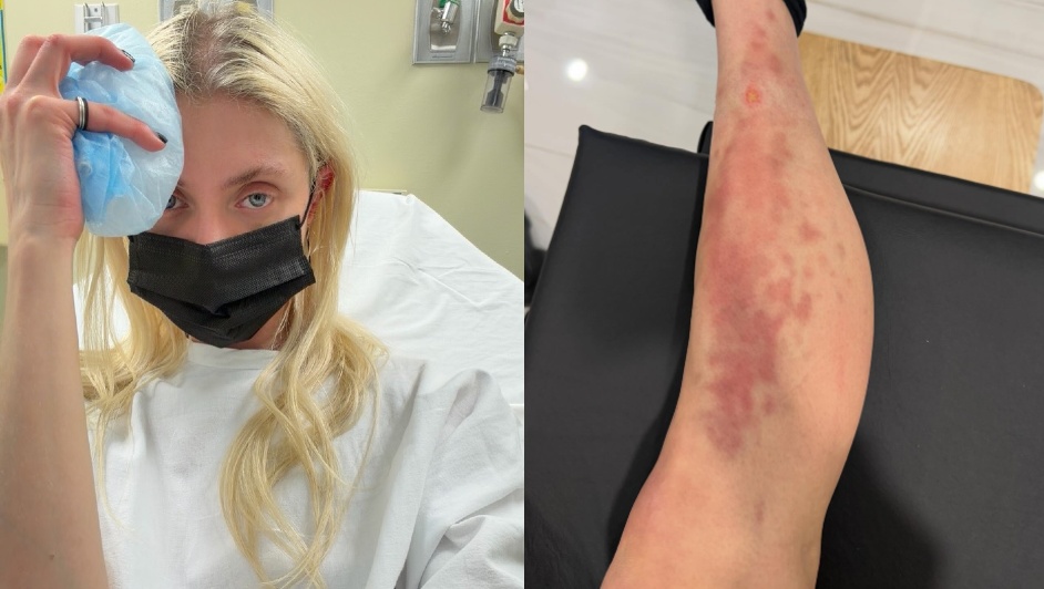 Taylor Momsen fue picada por una araña | Instagram