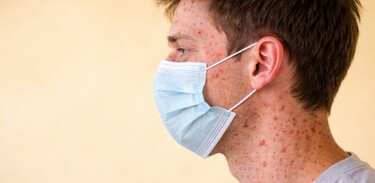 Secretaría de Salud en Tamaulipas analiza 50 casos sospechosos de sarampión y se espera resultados de 18 pacientes | Foto: IA