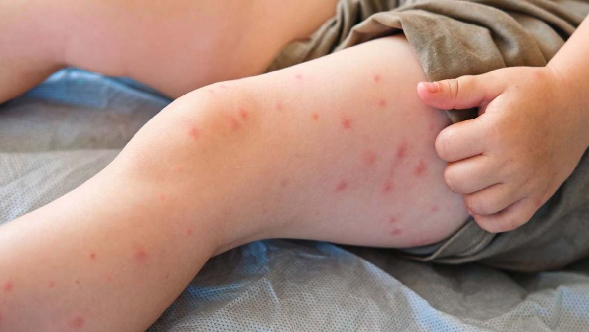 Nuevo León alcanza 59 casos de sarampión desde 2025 | Especial