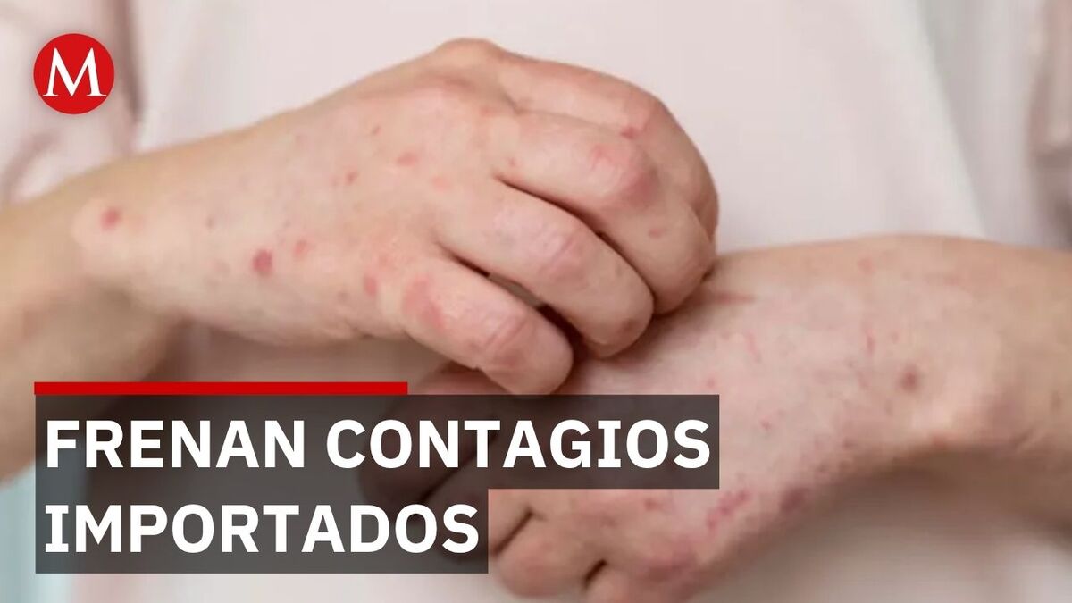 Sarampión en Oaxaca: Contagios son importados de California, no locales