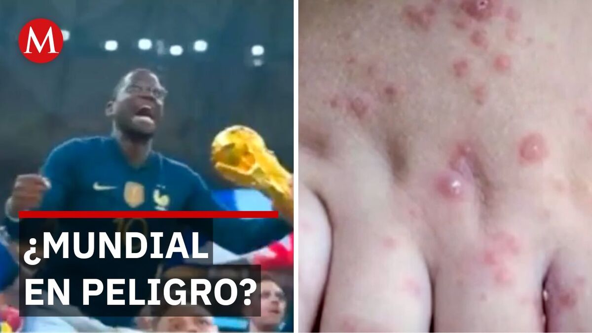 La OPS aclara si el brote de sarampión suspenderá la Copa del Mundo