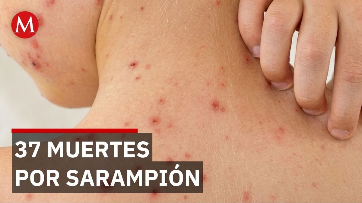 México enfrenta una crisis epidemiológica por sarampión en diversas entidades