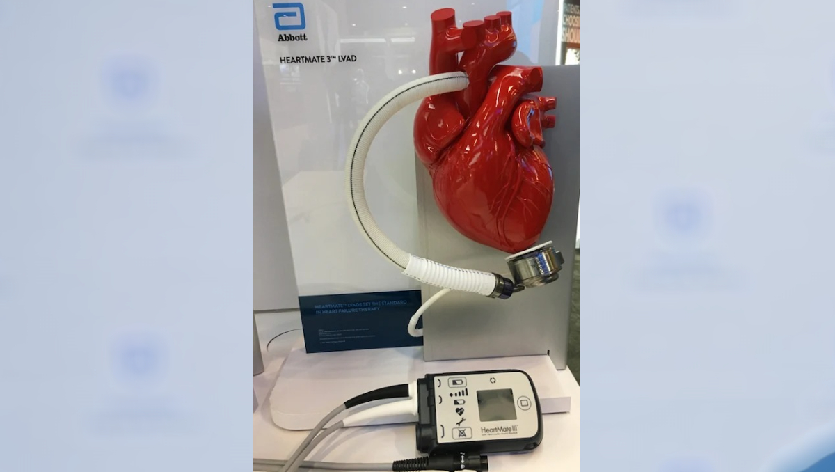 El dispositivo también conocido como 'Heartmate' es una alternativa para pacientes terminales (Foto: Cortesía)