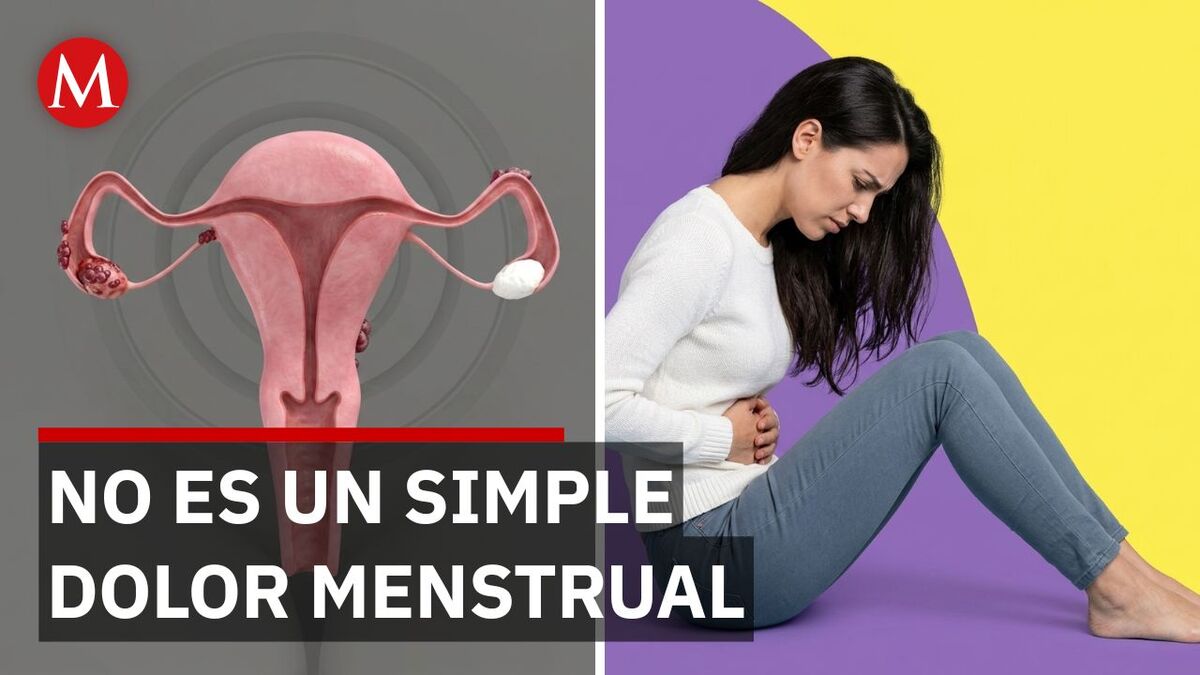 La alarmante razón por la que miles de mujeres sufren endometriosis sin saberlo
