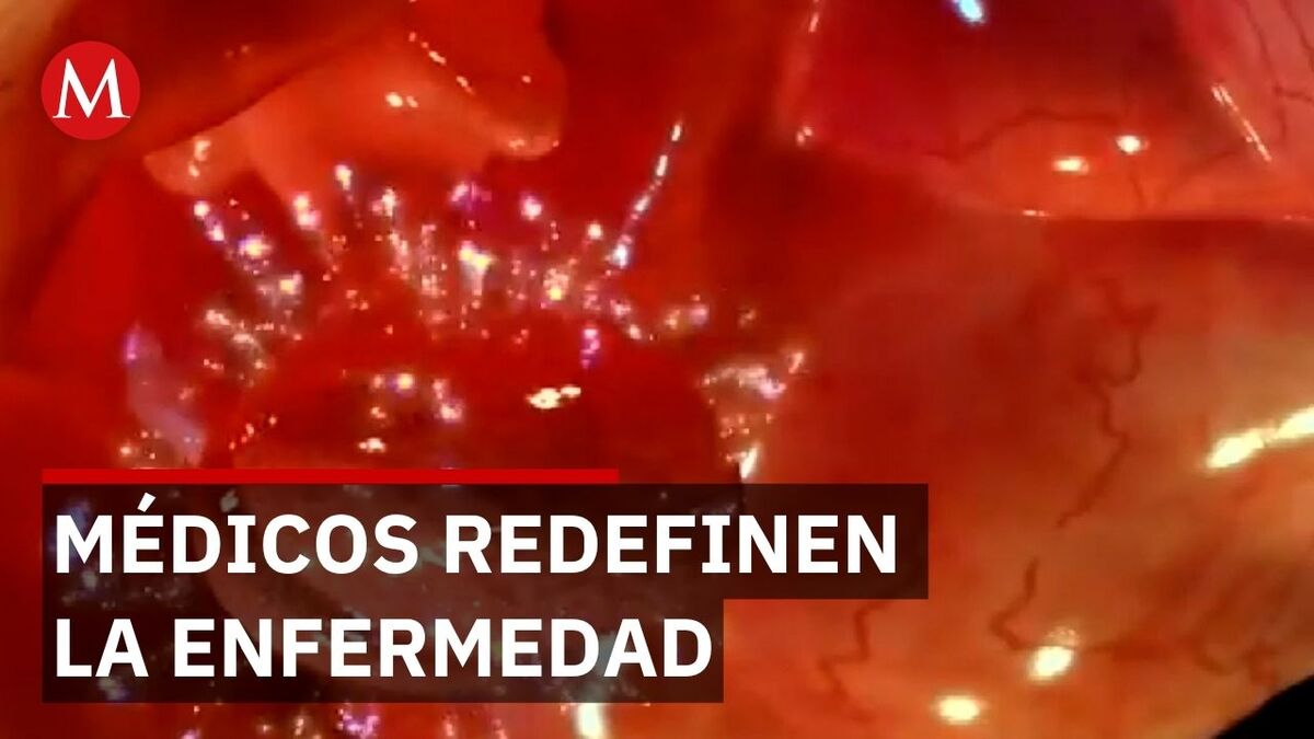 Especialistas cambian el nombre del síndrome de ovario poliquístico