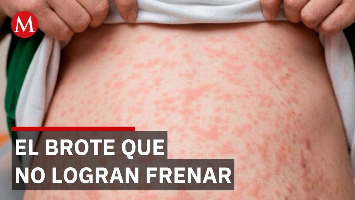 Alerta sanitaria en México: los contagios de sarampión se disparan a nivel nacional