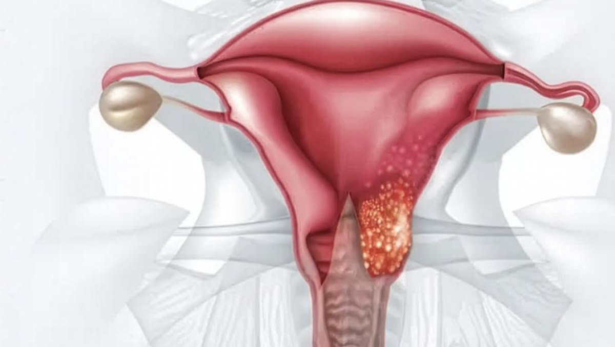 Evolución en el cáncer cervicouterino temprano: Cirugía radical abierta vs cirugía mínimamente invasiva (Shutterstock)