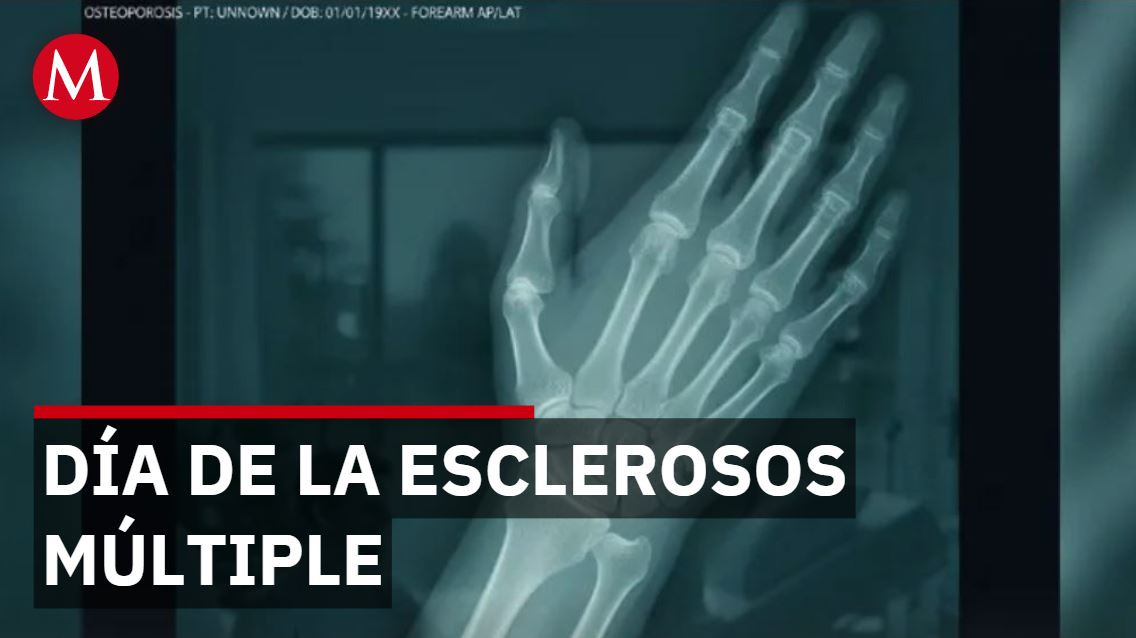 Día mundial de la esclerosos múltiple: Antonieta Sea