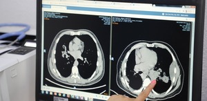 El cáncer de pulmón causa la muerte de 22 personas a diario, es decir, más de 8 mil mexicanos anualmente. | Foto: Javier Ríos