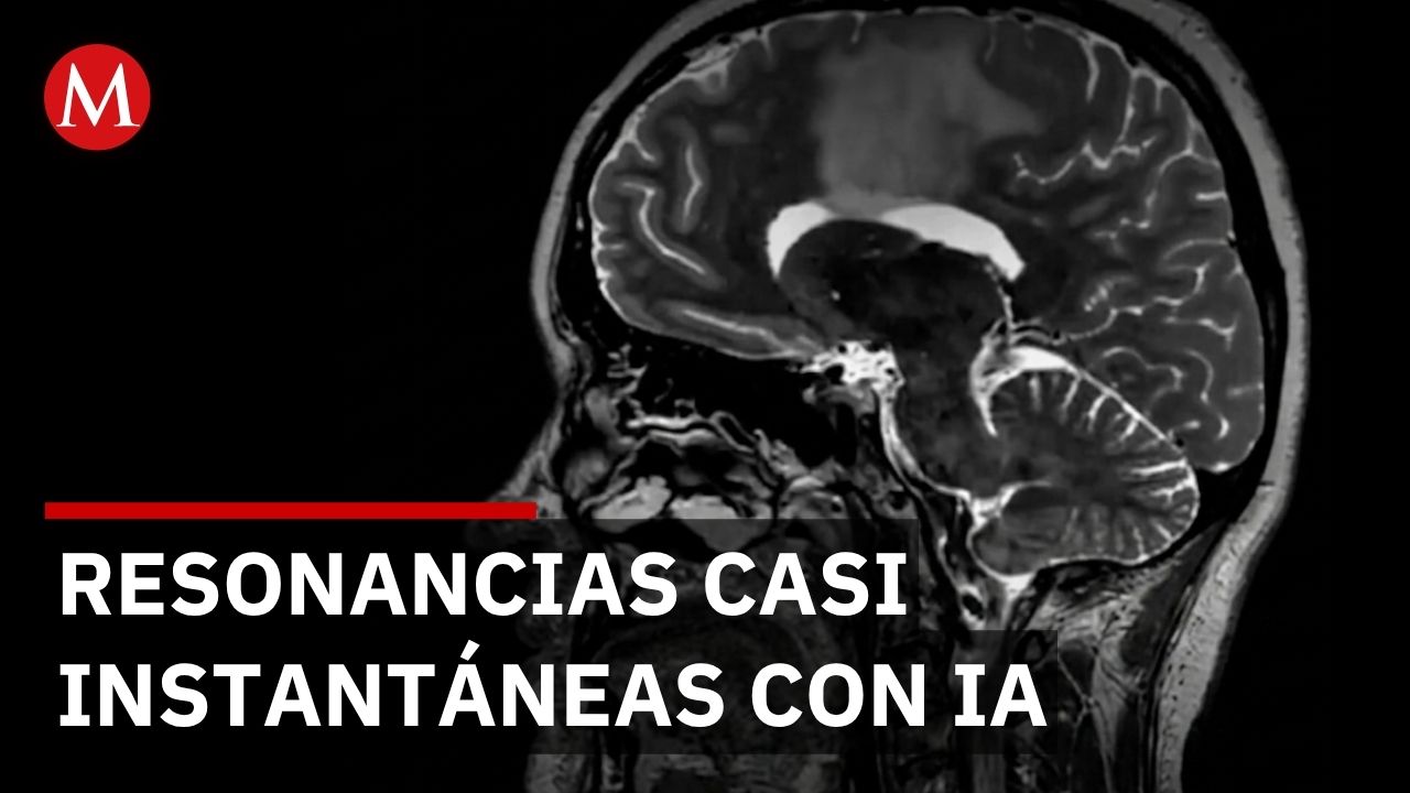 Investigadores españoles logran resonancias cerebrales en minutos con inteligencia artificial