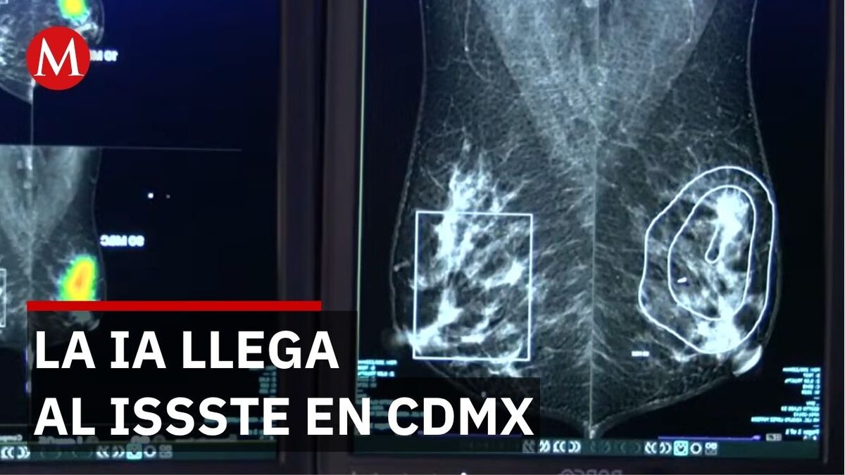 Inteligencia artificial detecta cáncer mama lesiones milimétricas