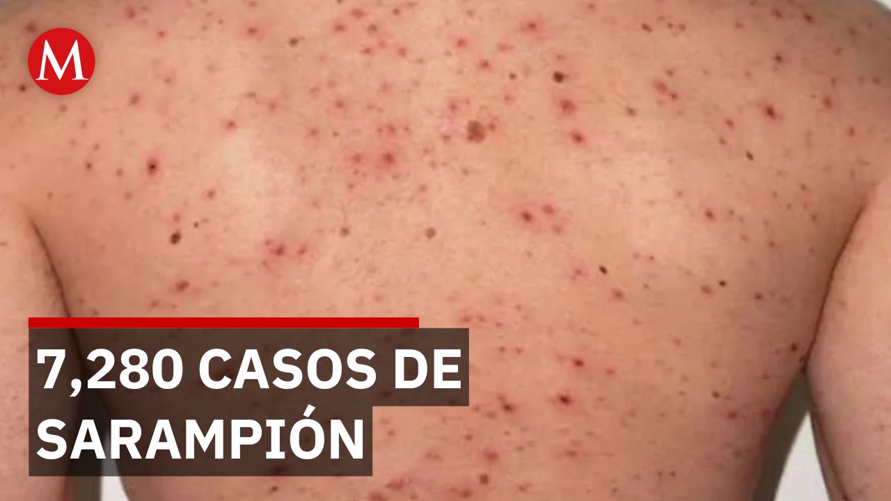 Jalisco registra 7280 casos de sarampión y 5 defunciones; brote concentrado en zona metropolitana