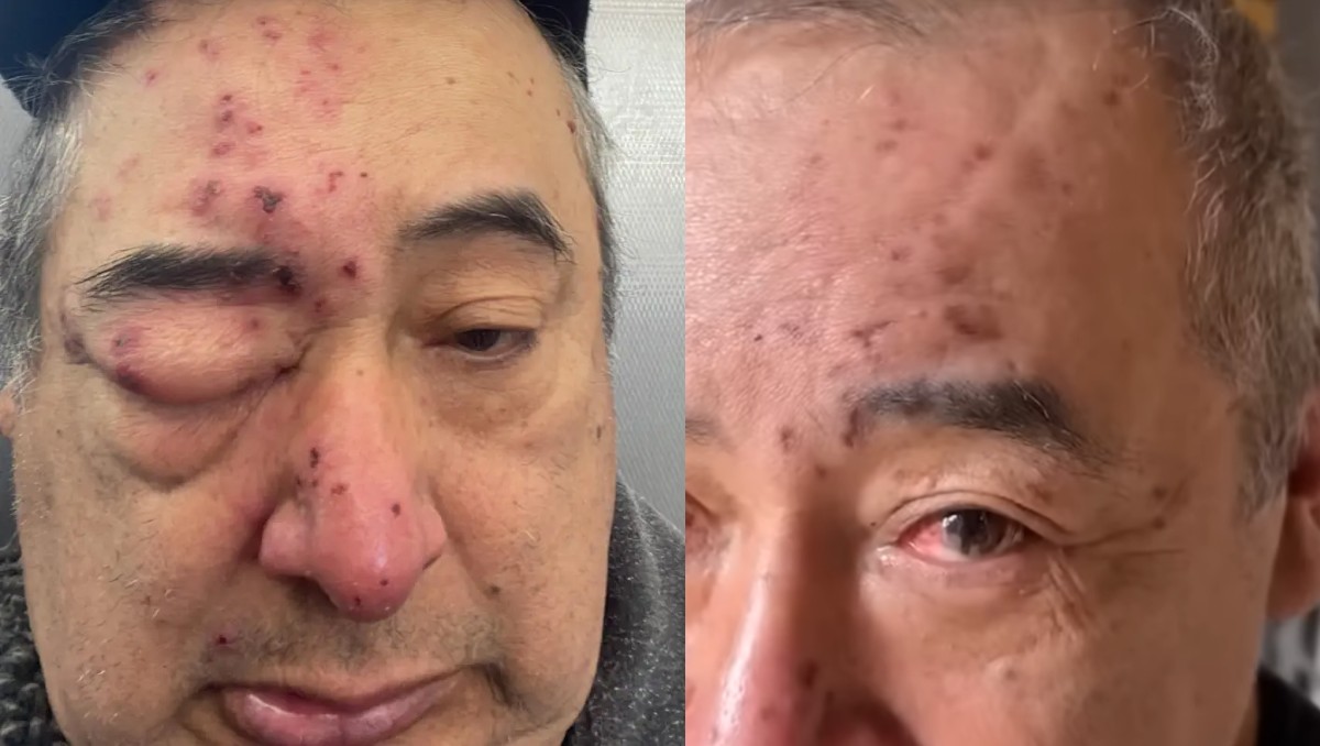 Un inquilino de Chicago afirmó que despertó con ratas mordiéndole la cara tras denunciar durante meses una infestación en su edificio.
