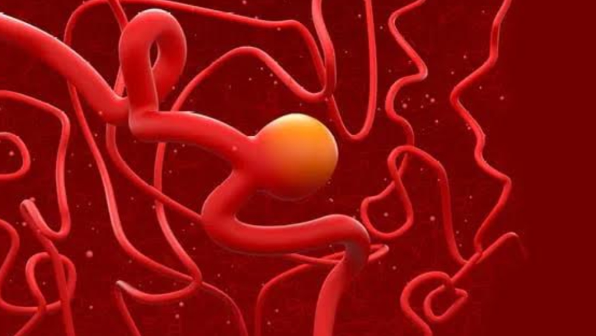 ¿Cuándo un dolor de cabeza es señal de un aneurisma cerebral? Síntomas y señales de alerta | Shutterstock