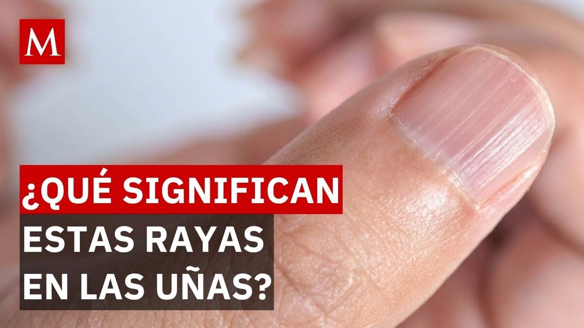 Líneas y surcos en las uñas: ¿Qué significan y qué enfermedades revelan?