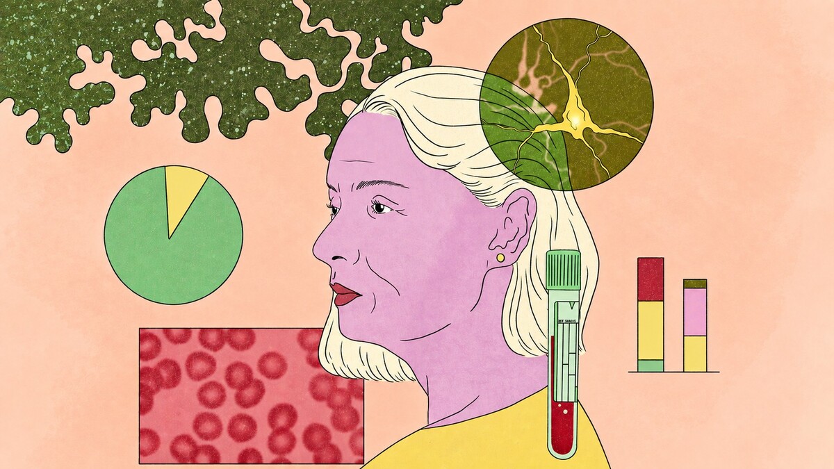 El año pasado, aprobaron dos pruebas de biomarcadores en sangre para el Alzheimer. | Michelle Mildenberg/The New York Times