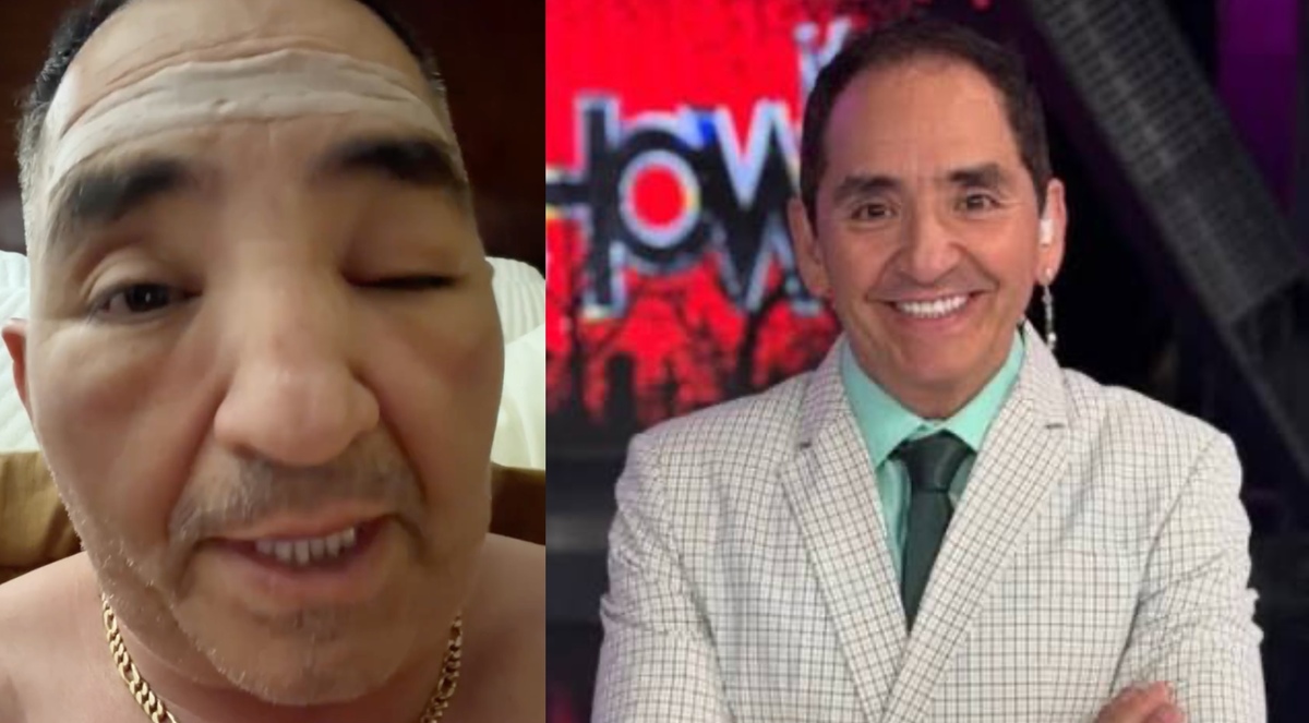 Ernesto Chavana preocupa por rostro golpeado. | ESPECIAL