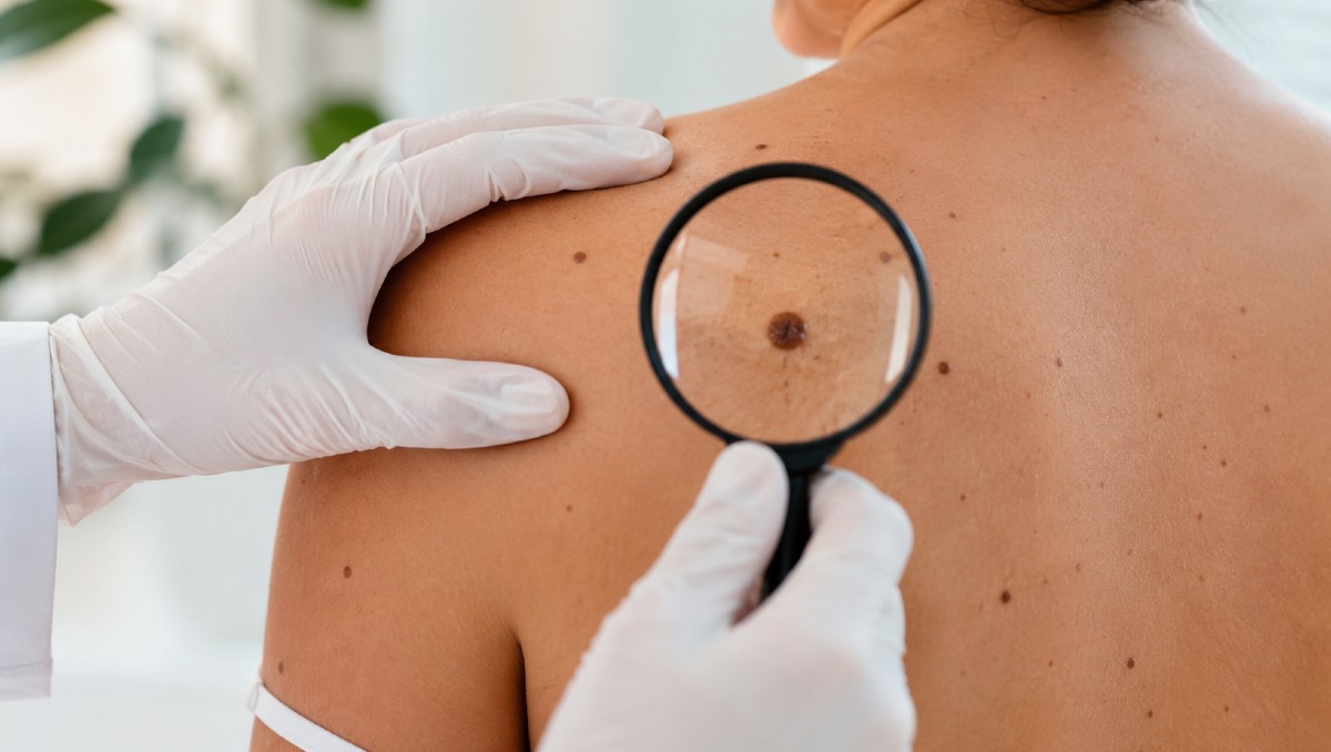 ¿Tienes un lunar? Señales que pueden indicar melanoma | IA DISCOVER