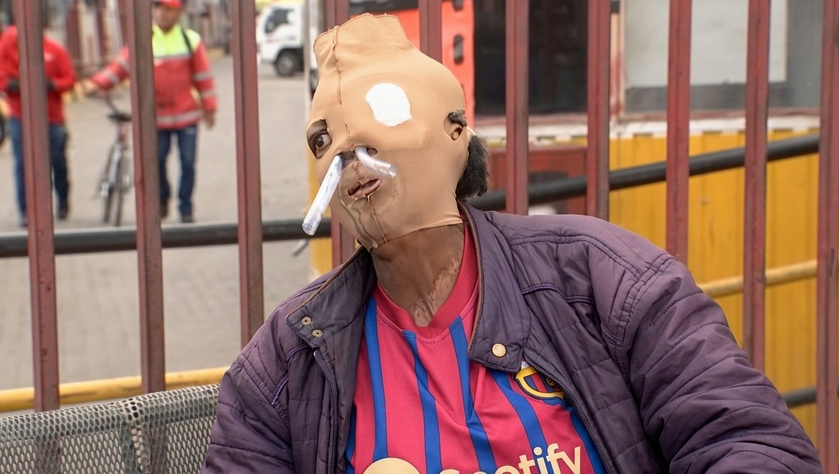 La historia de María Consuelo Córdoba, víctima de un ataque con ácido en Bogotá. | FOTO: Captura YouTube City TV