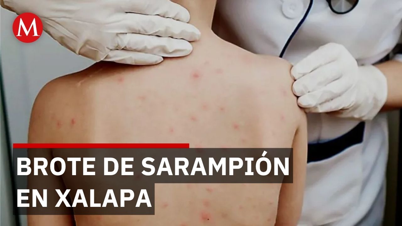 Brote de sarampión en hospital de Xalapa deja 2 muertos entre pacientes con cáncer