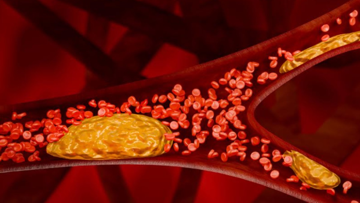 Aterosclerosis: Cómo detectar y prevenir la placa en arterias | Shutterstock