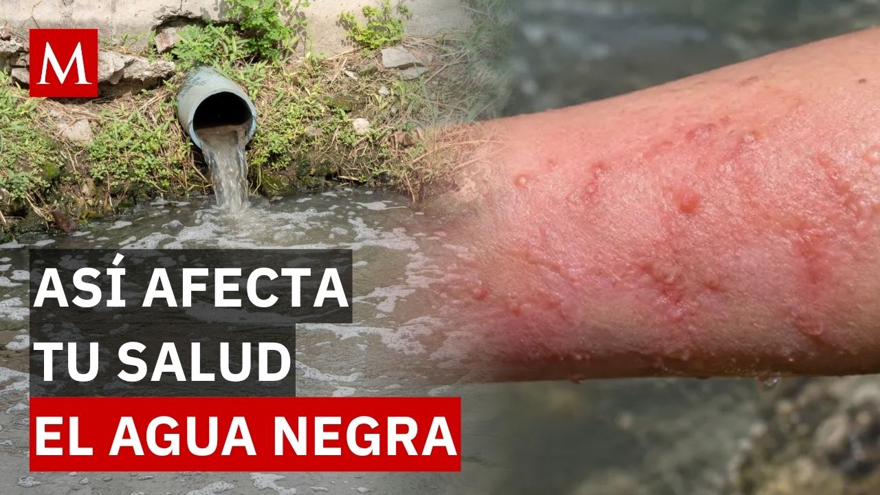 ¡Alerta en Guadalajara! Foliculitis, dermatitis y otros daños que el agua sucia deja en tu piel