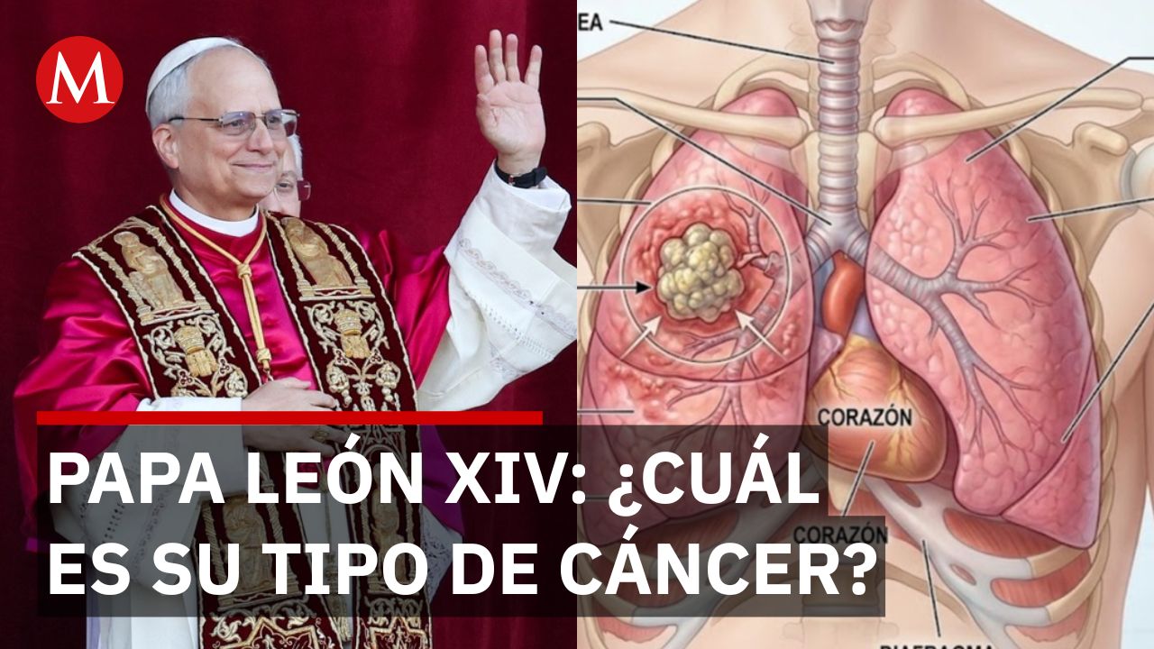 Adenocarcinoma pulmonar: ¿Cuál es el cáncer diagnosticado al Papa León XIV?